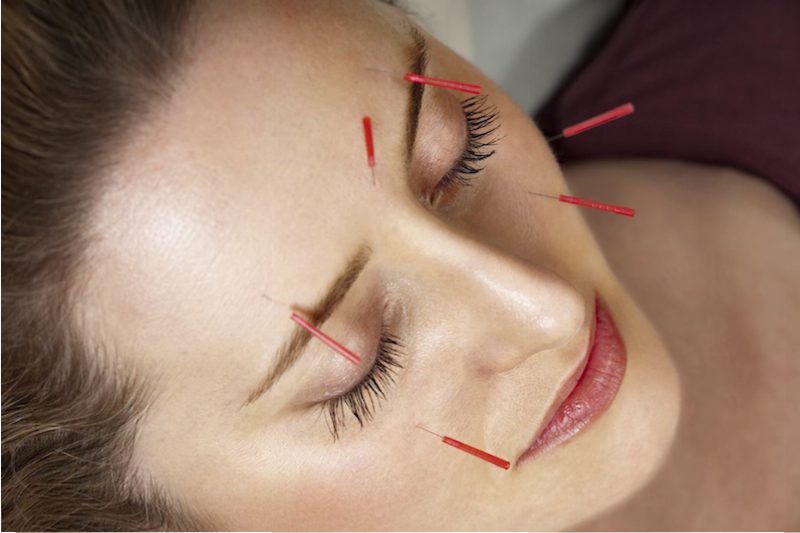 What Are The Types Of Dry Needling? How Electrical Stimulation Can Help 
