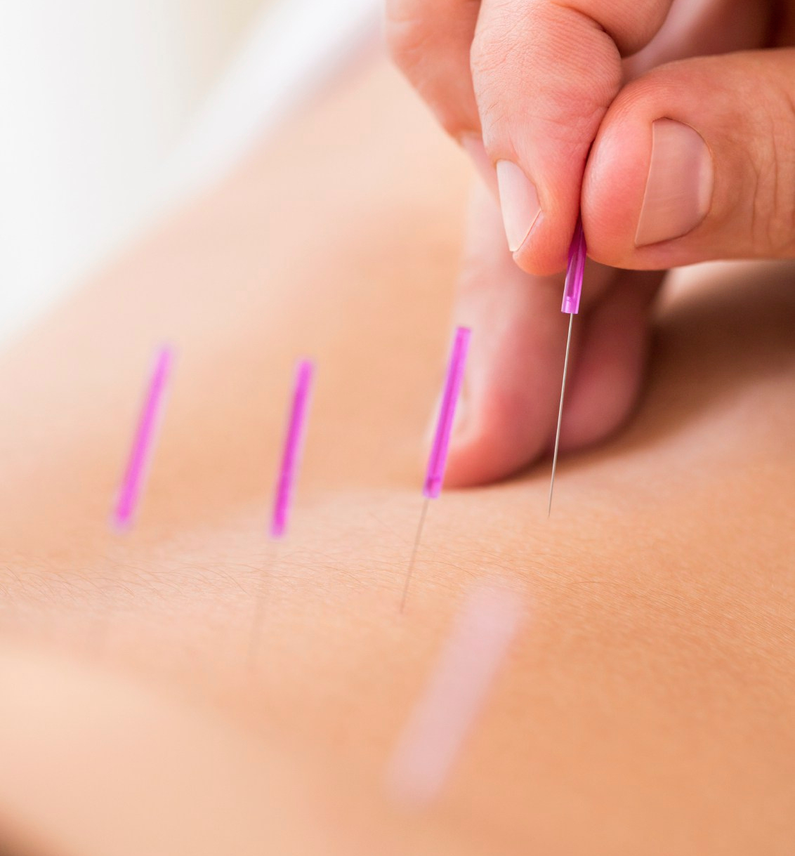 Dry needling: An innovative tool in treating pelvic-related conditions
