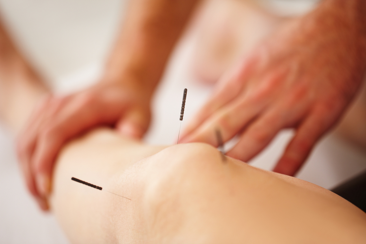 The Therapeutic Effects of Dry Needling Explained
